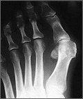 Hallux Valgus spalk